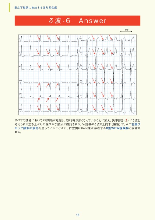 臨床心電図解析の実際 - 不整脈関連波形異常編