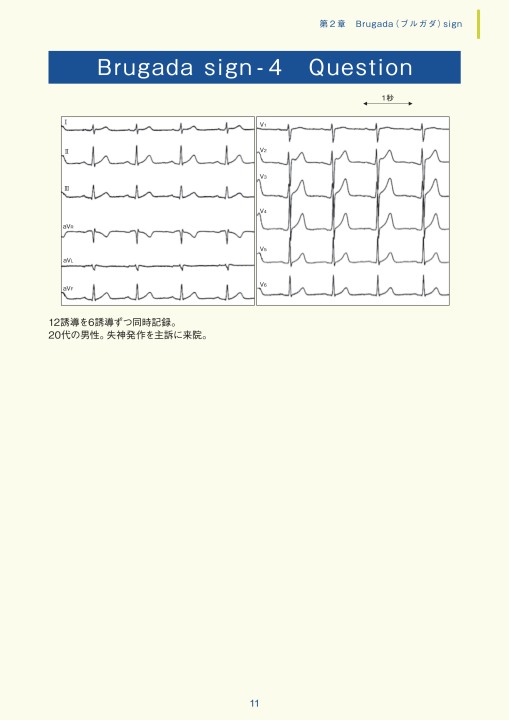 第2章｜臨床心電図解析の実際 - 不整脈関連波形異常編