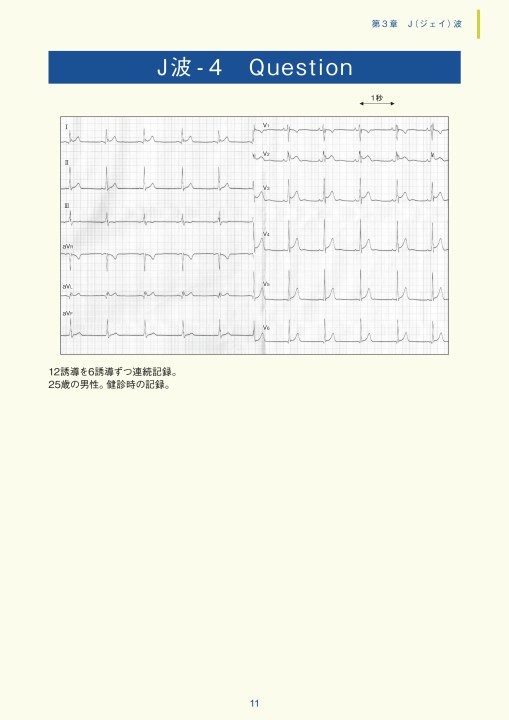 第3章｜臨床心電図解析の実際 - 不整脈関連波形異常編