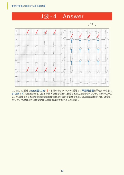 ファッション通販 安い 第3章｜臨床心電図解析の実際 不整脈関連波形異常編 - 臨床医学