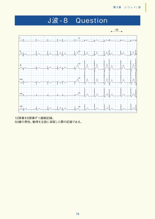 第3章｜臨床心電図解析の実際 - 不整脈関連波形異常編