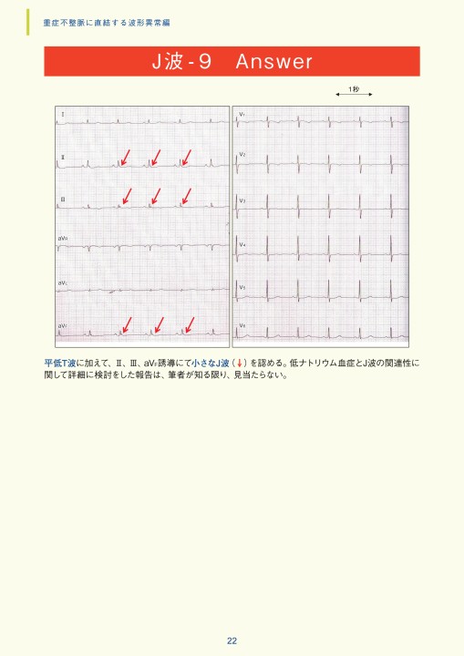 第3章｜臨床心電図解析の実際 - 不整脈関連波形異常編