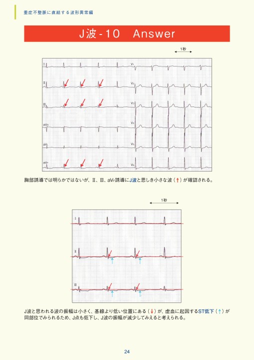 第3章｜臨床心電図解析の実際 - 不整脈関連波形異常編
