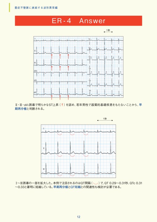 第4章｜臨床心電図解析の実際 - 不整脈関連波形異常編