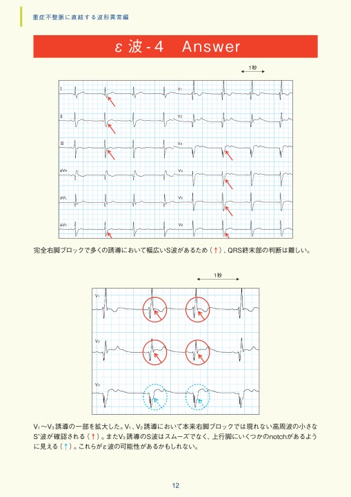 第5章｜臨床心電図解析の実際 - 不整脈関連波形異常編