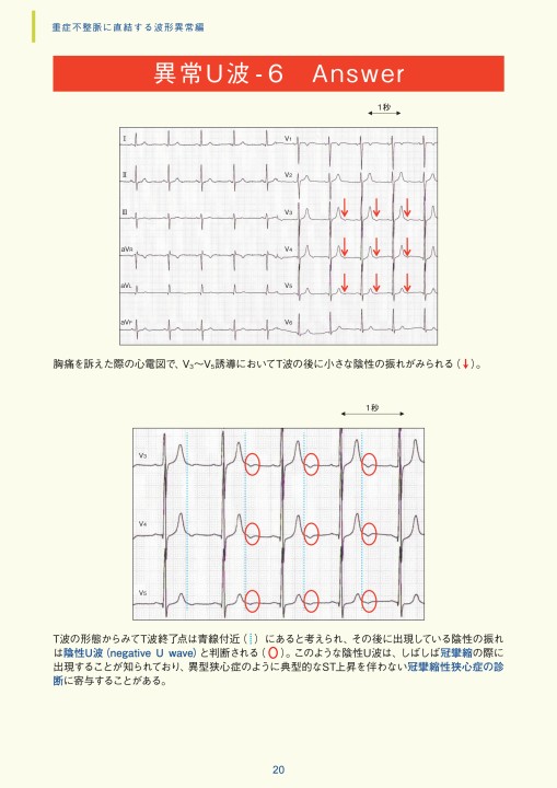第8章｜臨床心電図解析の実際 - 不整脈関連波形異常編