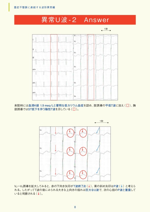 第8章｜臨床心電図解析の実際 - 不整脈関連波形異常編