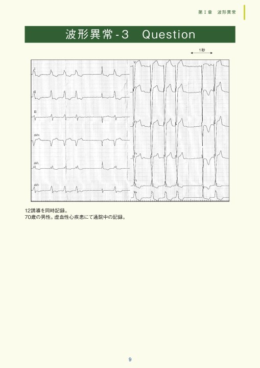 臨床心電図解析の実際 - 複雑な心電図の解析編