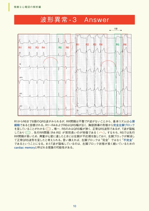 臨床心電図解析の実際 - 複雑な心電図の解析編