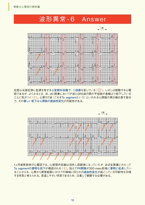 臨床心電図解析の実際 - 複雑な心電図の解析編
