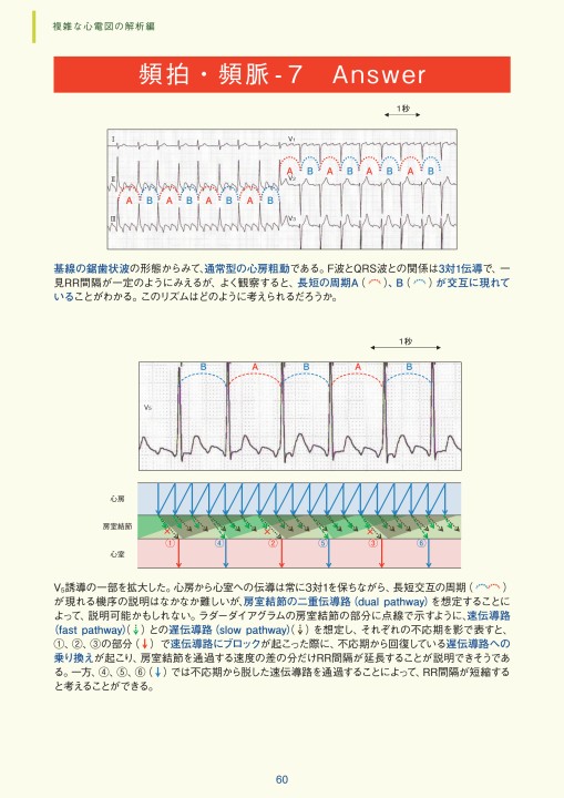 臨床静脈学 硬膜動静脈瘻の画像診断(dural arteriovenous fistula:AVF)
