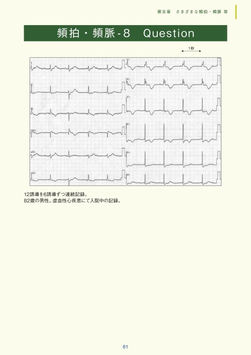 臨床心電図解析の実際 - 複雑な心電図の解析編