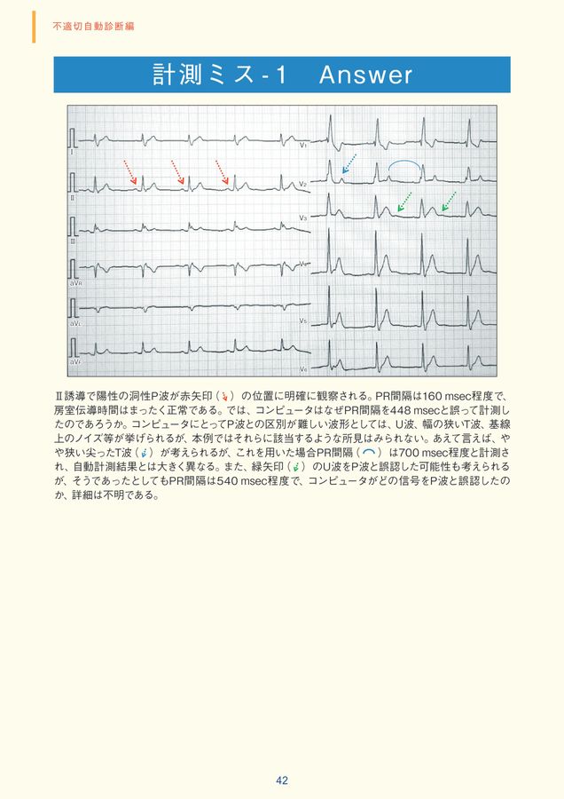 臨床心電図解析の実際 ― 不適切自動診断編