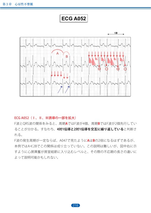 臨床心電図解析の実際 - 不整脈編 第3章