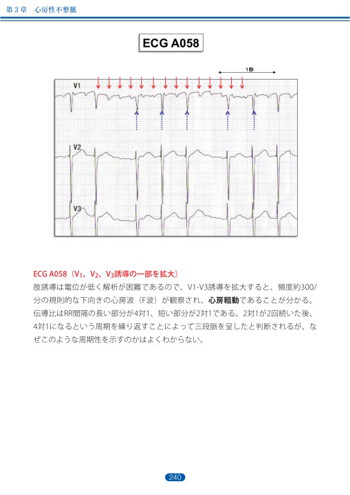 臨床心電図解析の実際 - 不整脈編 第3章