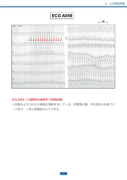 臨床心電図解析の実際 - 不整脈編 第3章