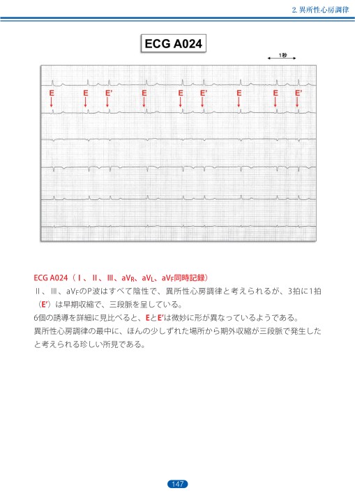 臨床心電図解析の実際 - 不整脈編 第3章