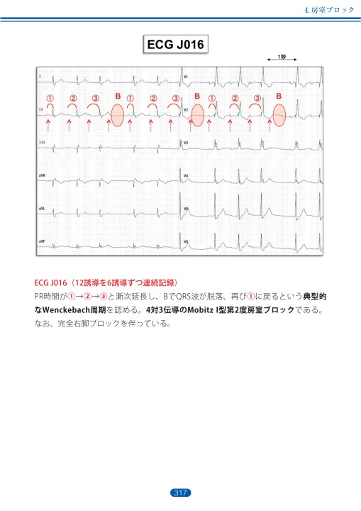 臨床心電図解析の実際 - 不整脈編 第4章