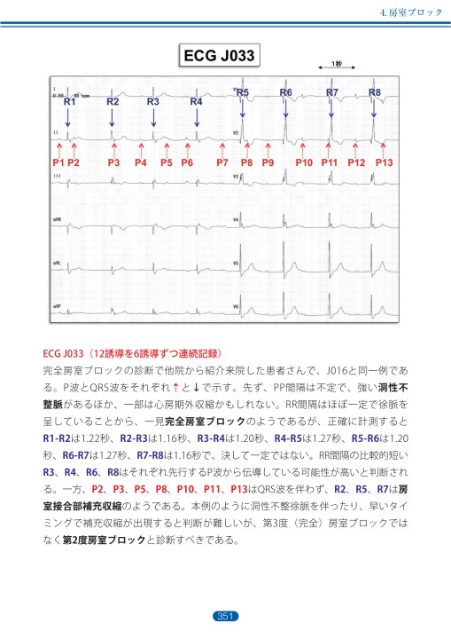 臨床心電図解析の実際 - 不整脈編 第4章