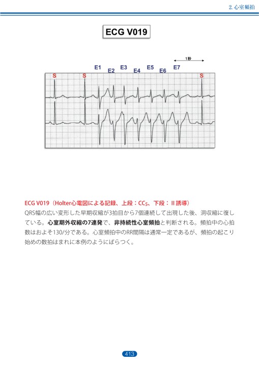 臨床心電図解析の実際 - 不整脈編 第5章