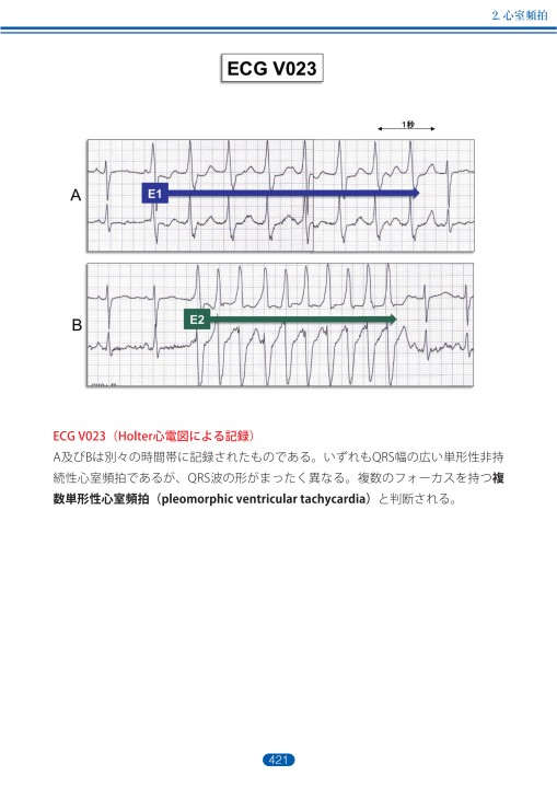 臨床心電図解析の実際 - 不整脈編 第5章