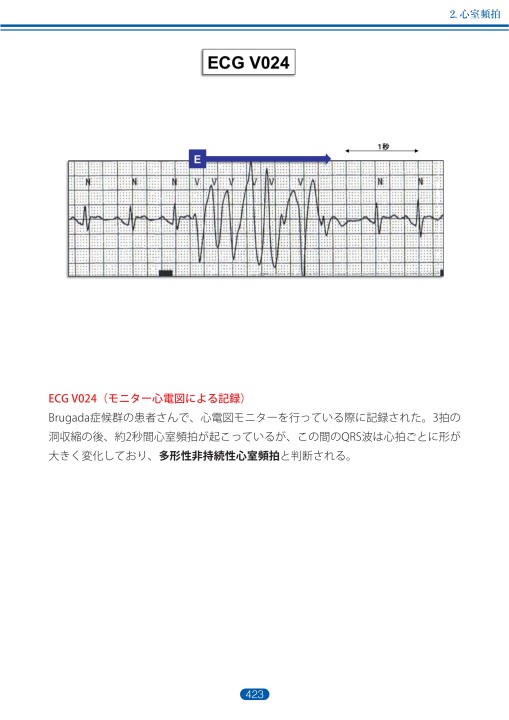 臨床心電図解析の実際 - 不整脈編 第5章