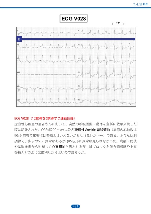 臨床心電図解析の実際 - 不整脈編 第5章
