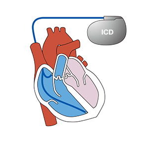 図1　植込み型除細動器 (ICD)
